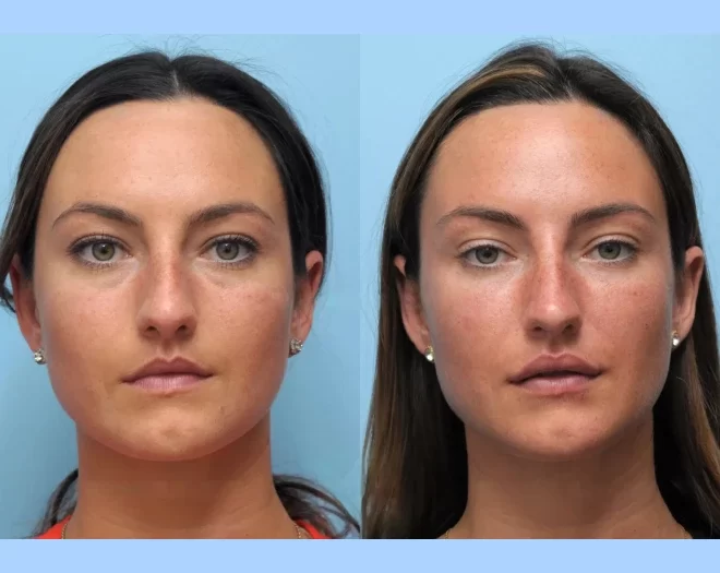 Achieve a Sculpted Face at the Best Aesthetic Clinics in Dubai for Thread Lift