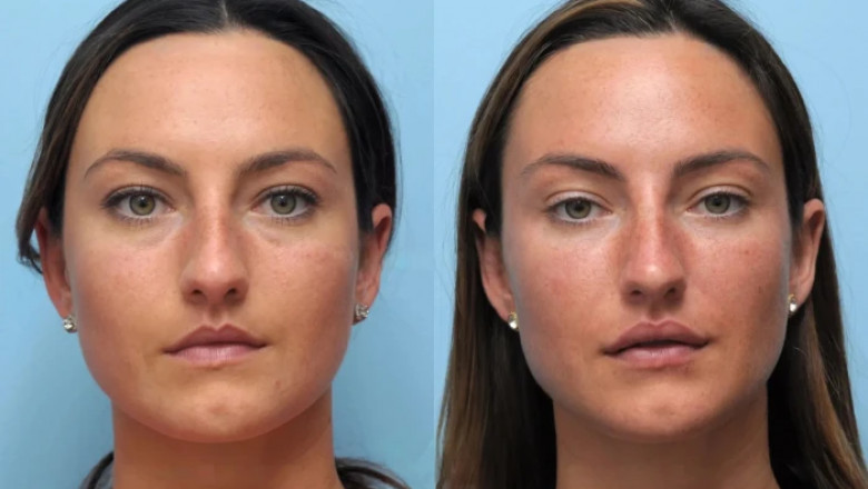 Benefits of Choosing Thread Lift Treatment in Dubai Over Surgery