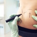 Safe & Effective: Tummy Tuck Recovery Tips from Dubai Experts