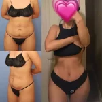 Best Doctors in Dubai for Tummy Tuck: The Latest Innovations