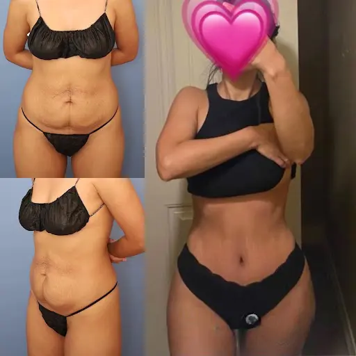 How to Choose the Best Doctors in Dubai for Your Tummy Tuck