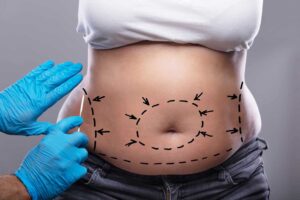 Tummy Tuck Dubai: How to Prepare for Your Tummy Tuck Procedure