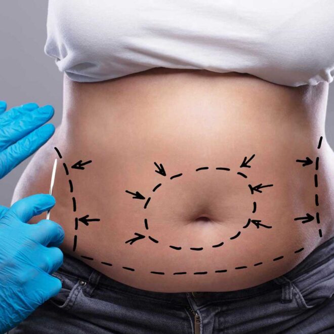 Tummy Tuck Dubai: How to Prepare for Your Tummy Tuck Procedure