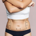 Tummy Tuck Dubai: How to Choose the Right Surgeon for Your Tummy Tuck Surgery