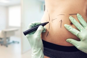 Safe & Effective: Tummy Tuck Recovery Tips from Dubai Experts