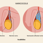 Does Hitting the Gym Cause Varicocele?
