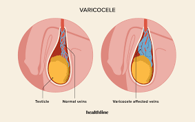 Does Hitting the Gym Cause Varicocele?