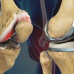Finding the Best Knee Replacement Surgeon in Jaipur: What You Need to Know