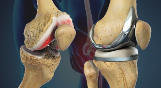 Finding the Best Knee Replacement Surgeon in Jaipur: What You Need to Know