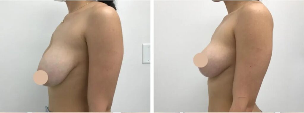 breast lift in dubai