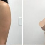 Can a Breast Lift Surgery in dubai Be Combined with a Brazilian Butt Lift?
