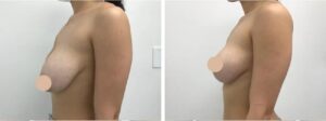 Can a Breast Lift Surgery in dubai Be Combined with a Brazilian Butt Lift?