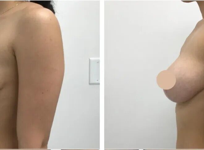 Can a Breast Lift Surgery in dubai Be Combined with a Brazilian Butt Lift?