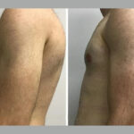 Exploring the Benefits of Gynecomastia Srugery in dubai