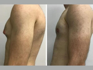 Exploring the Benefits of Gynecomastia Srugery in dubai