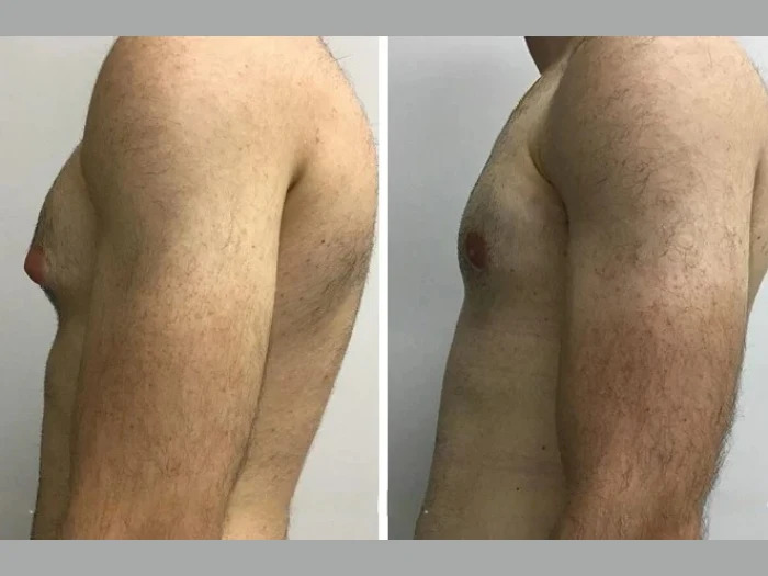 Exploring the Benefits of Gynecomastia Srugery in dubai