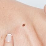 Is Chemical Mole Removal Treatment Good?