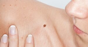 Is Chemical Mole Removal Treatment Good?