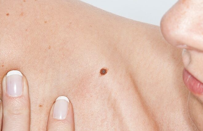Is Chemical Mole Removal Treatment Good?