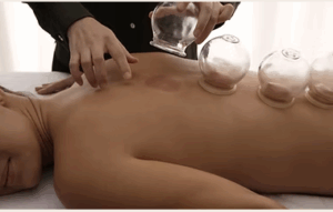 Unlocking Wellness Through Cupping Massage Therapy