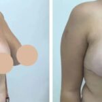 How to Prepare Mentally and Physically for Breast Reduction Surgery in dubai