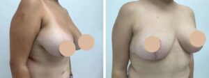 How to Prepare Mentally and Physically for Breast Reduction Surgery in dubai
