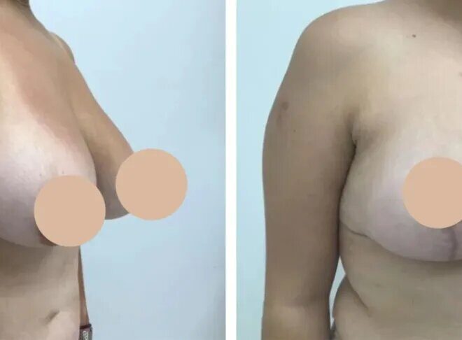 How to Prepare Mentally and Physically for Breast Reduction Surgery in dubai