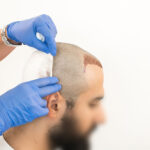 Riyadh’s Hair Transplant Boom | Royal Clinic