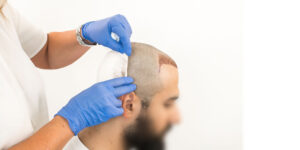 Riyadh’s Hair Transplant Boom | Royal Clinic