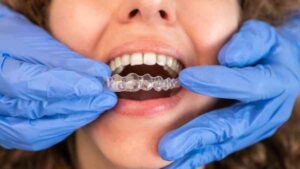 invisalign Winchester