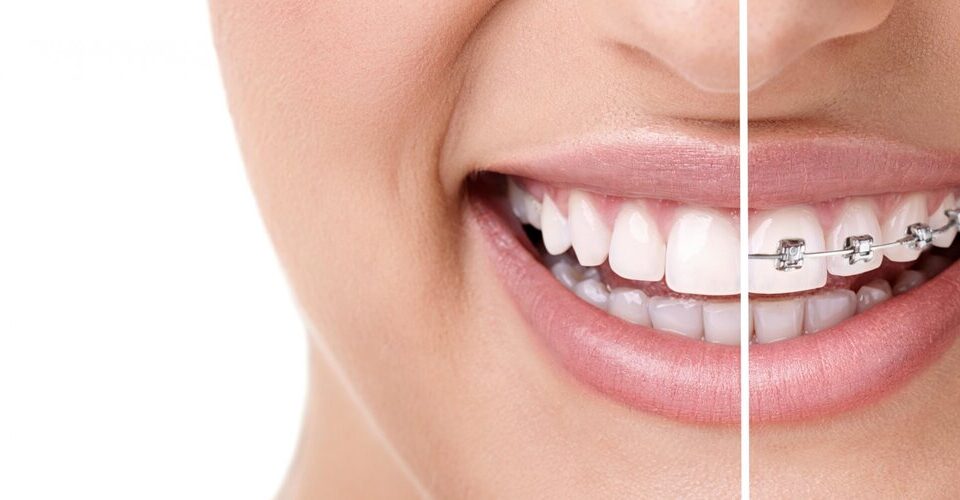 Damon braces treatment without extraction