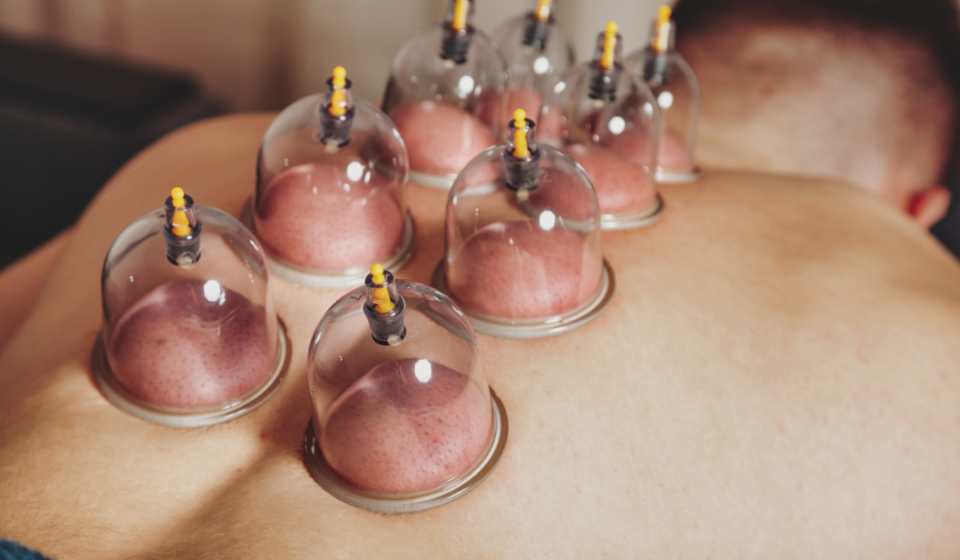 cupping treatment