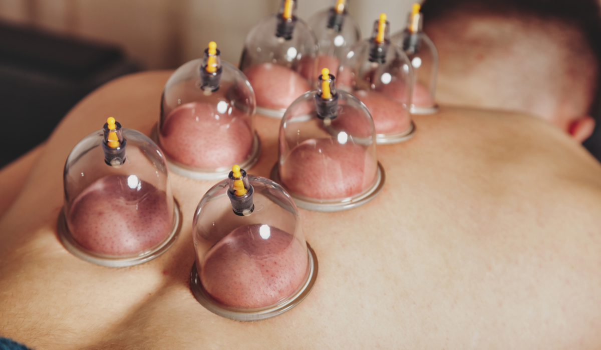 cupping treatment