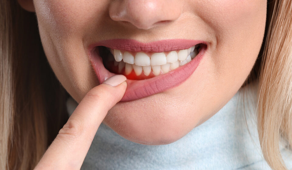 Gum Swelling 2 Weeks After Tooth Extraction