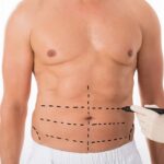 What to Know About Liposuction Surgery in Islamabad Before Your Procedure