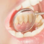 Tartar on Back Teeth