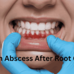 Root Canal