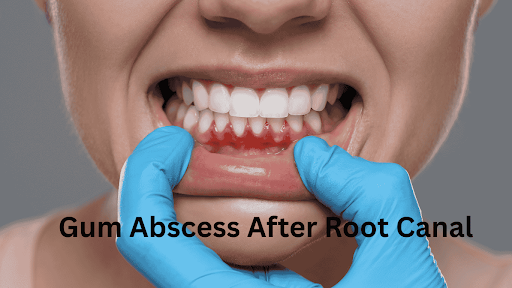 Root Canal
